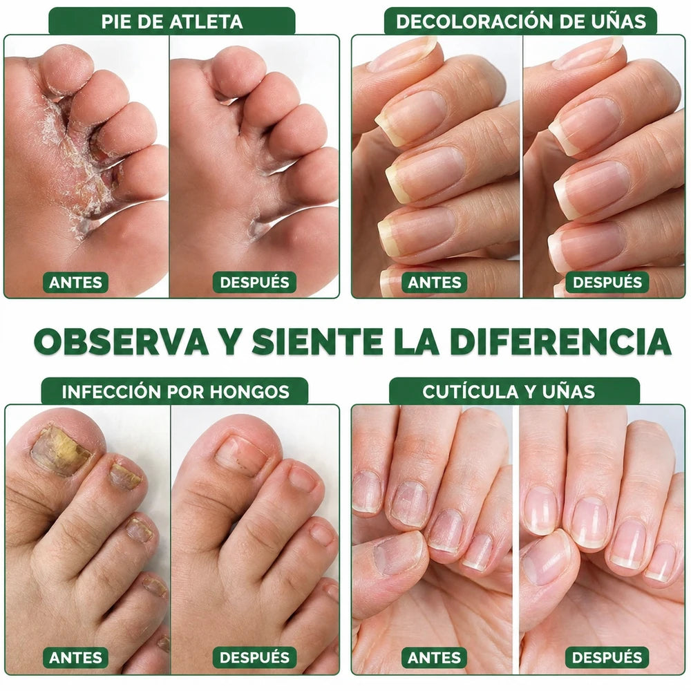 🥇 7DAYS™ – Recupera la Apariencia Sana de tus Uñas 🔥 OFERTA 2x1